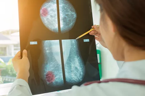 Diagnóstico de cáncer de mama ante una prueba de contraste