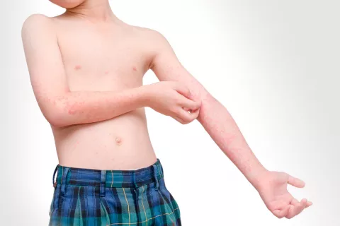 Niño sufre dermatitis atópica