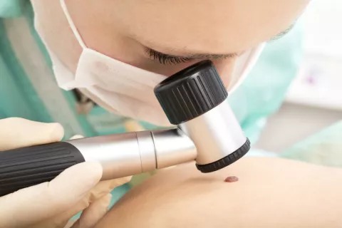 Descubren cómo se desarrolla el melanoma