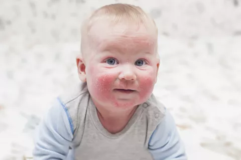 Bebé con eczema infantil