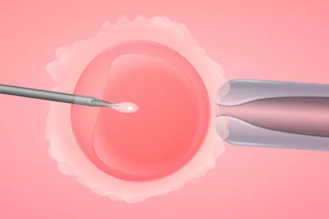 Fecundación in vitro