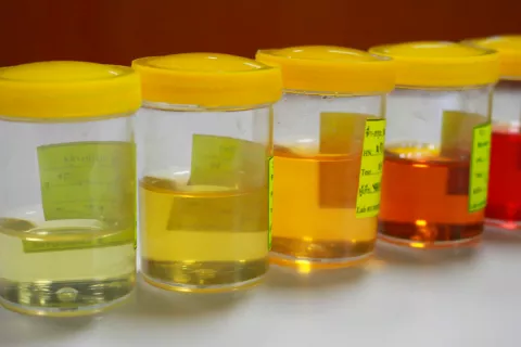 Análisis de orina con síntomas de hematuria