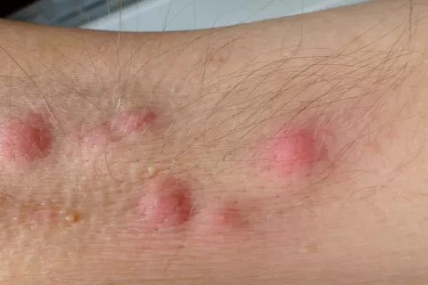 La hidradenitis supurativa deteriora la calidad de vida