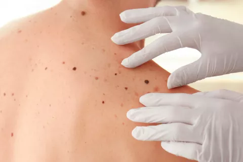 Persona en el médico por un melanoma