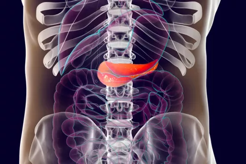 Pancreatitis