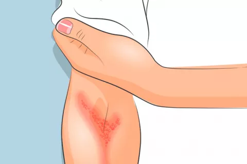 Persona con psoriasis en el brazo