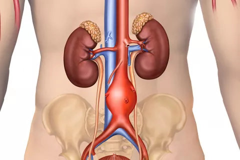 "Stent" aneurisma