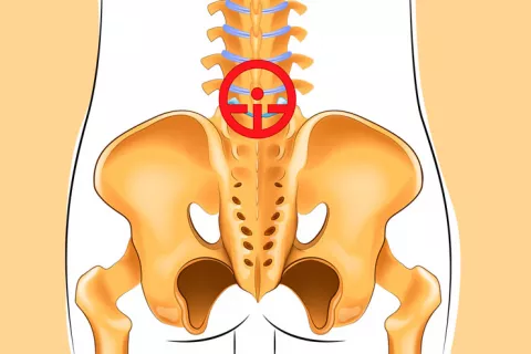 Espondilitis anquilosante