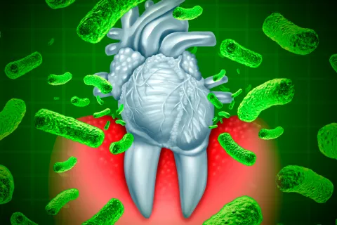 Periodontitis, descubren cómo ataca