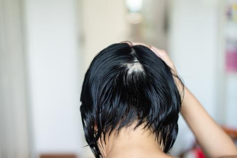 Una mujer mostrando su alopecia en el cabello de la cabeza