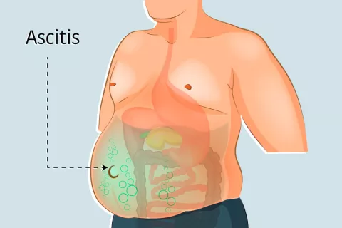 Hinchazón abdominal por ascitis