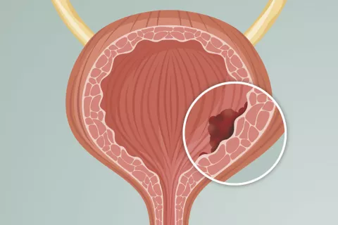 Tumor en la vejiga