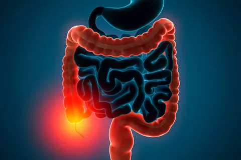 Colitis ulcerosa en el intestino