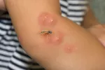 En verano se incrementa el riesgo de anafilaxia infantil por picaduras Picaduras de avispa en niña alérgica