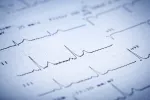 Evidencia de arritmia cardiaca Arritmia cardiaca
