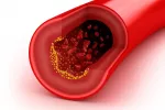 Hipercolesterolemia