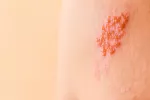 herpes zoster