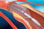 Stent coronario, en qué consiste y cuándo está indicado Stent coronario