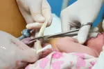 El COVID causa lesiones en placenta y cordón umbilical de embarazadas Medicos cortando el cordón umbilical entre un recién nacido y la placenta