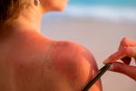 Mujer tomando el sol sin protección con la piel quemada