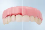 Encías sanas vs gingivitis Comparación de encías sanas vs gingivitis en la representación 3D detallada.