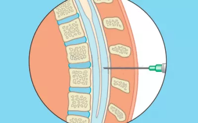Punción lumbar Punción lumbar