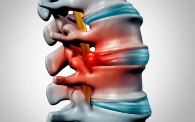 El dolor de espalda afecta a 8 de cada 10 personas en el mundo