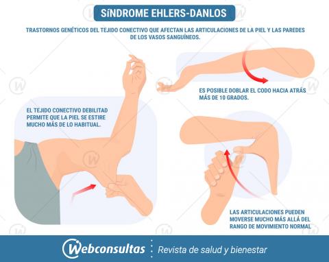 Ilustración con los síntomas del síndrome Ehlers-Danlos