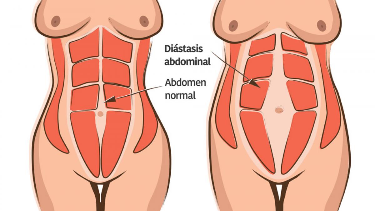 Cómo identificar si tienes diástasis abdominal y cómo prevenirla