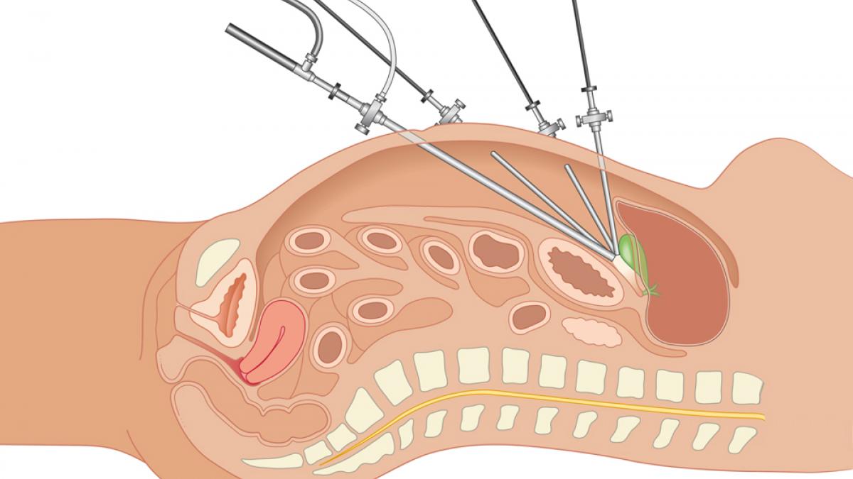 LAPAROSCOPIA