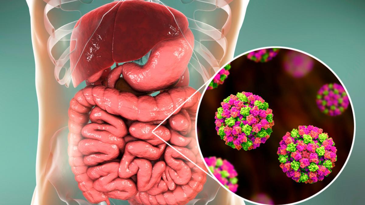 Norovirus Causas, síntomas y tratamiento