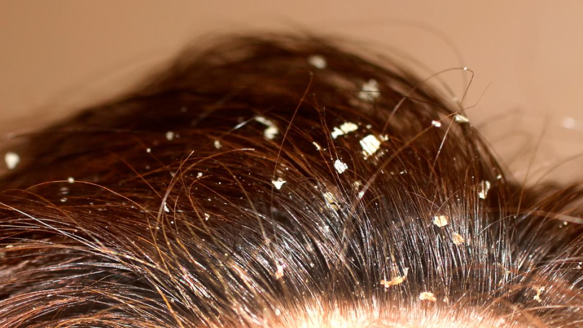 Persona australiana Específicamente Inmigración Descamación del cuero cabelludo, qué es y posibles causas