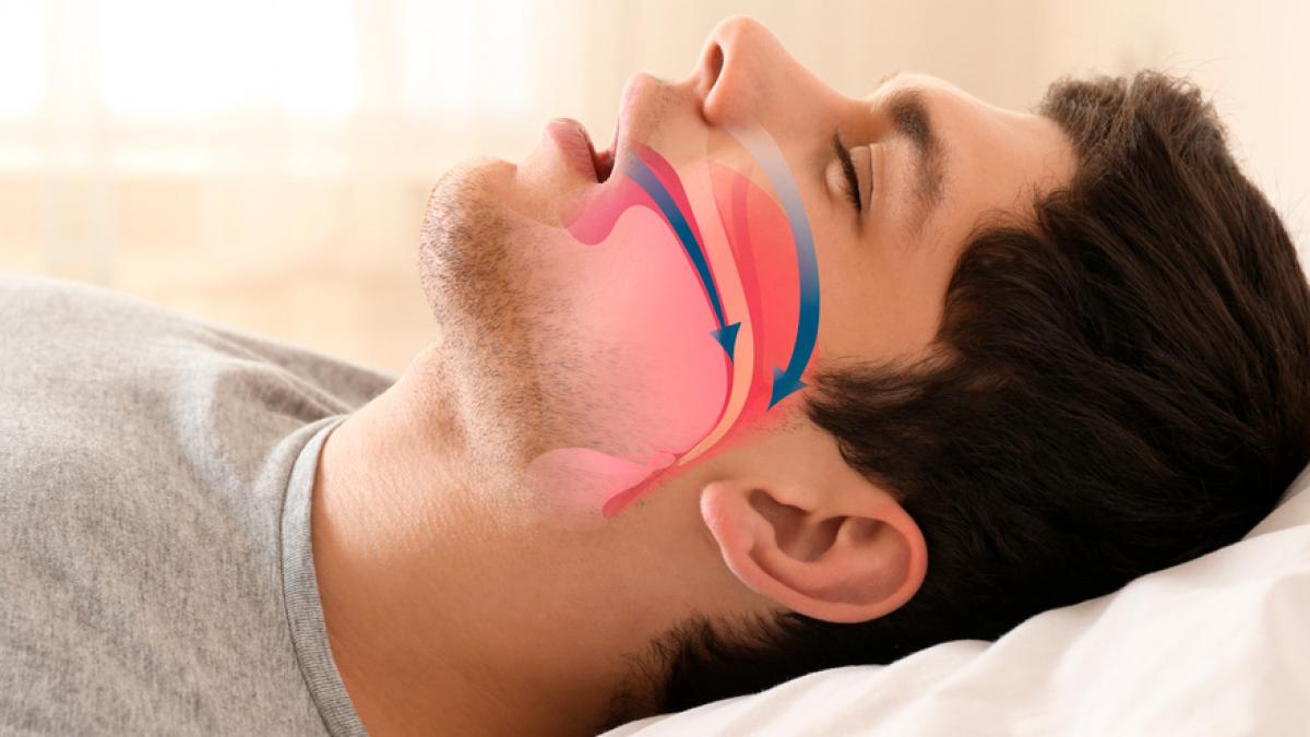 La sanidad pública madrileña utiliza un novedoso dispositivo que evita la  apnea del sueño