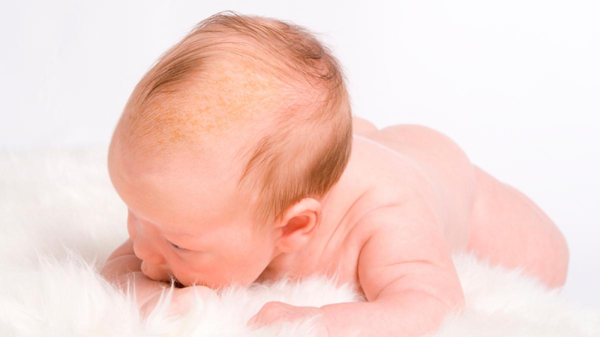 Costra láctea en bebés recién nacidos